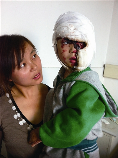 温州:邻居土制氢气爆炸 六岁男孩被炸得面目全