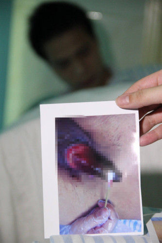 刘先生向记者提供术后治疗过程中阴茎坏死发黑的图片。