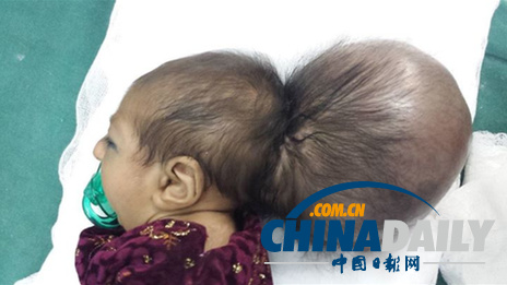 阿富汗双头女婴借助手术成功摘掉多余头颅（图）