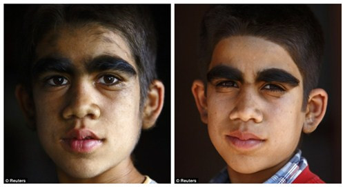布德哈索基的孩子接受激光治疗前后的照片对比。