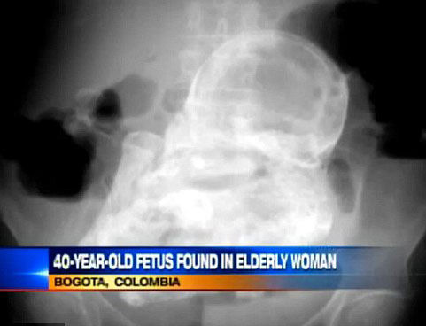 哥伦比亚首都波哥大一名82岁老妪因为腹内疼痛到医院就诊，却意外发现腹中有一个40年前因为宫外孕死亡的胎儿。死胎现在已经完全钙化，变成医学上所谓的“石胎”。
