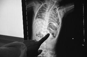 　X光片里，绣花针完全扎进左肾，取出后已断成两截